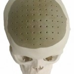 Reconstruyen 75% de un cráneo con implantes impresos en 3D